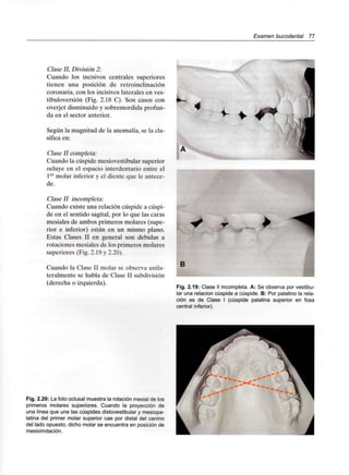 Examen bucodental 11
Clase II, División 2:
Cuando los incisivos centrales superiores
tienen una posición de retroinclinación
coronaria, con los incisivos laterales en ves-
tibuloversión (Fig. 2.18 C). Son casos con
overjet disminuido y sobremordida profun-
da en el sector anterior.
Según la magnitud de la anomalía, se la cla-
sifica en:
Clase II completa:
Cuando la cúspide mesiovestibular superior
ocluye en el espacio interdentario entre el
1er molar inferior y el diente que le antece-
de.
Clase II incompleta:
Cuando existe una relación cúspide a cúspi-
de en el sentido sagital, por lo que las caras
mesiales de ambos primeros molares (supe-
rior e inferior) están en un mismo plano.
Estas Clases II en general son debidas a
rotaciones mesiales de los primeros molares
superiores (Fig. 2.19 y 2.20).
Cuando la Clase II molar se observa unila-
teralmente se habla de Clase II subdivisión
(derecha o izquierda).
B
Fig. 2.19: Clase II incompleta. A: Se observa por vestibu-
lar una relación cúspide a cúspide. B: Por palatino la rela-
ción es de Clase I (cúspide palatina superior en fosa
central inferior).
Fig. 2.20: La foto oclusal muestra la rotación mesial de los
primeros molares superiores. Cuando la proyección de
una línea que une las cúspides distovestibular y mesiopa-
latina del primer molar superior cae por distal del canino
del lado opuesto, dicho molar se encuentra en posición de
mesiorrotación.
 