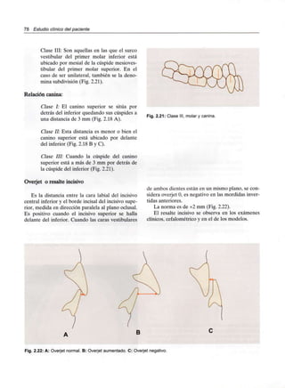 78 Estudio clínico del paciente
Clase III: Son aquellas en las que el surco
vestibular del primer molar inferior está
ubicado por mesial de la cúspide mesioves-
tibular del primer molar superior. En el
caso de ser unilateral, también se la deno-
mina subdivisión (Fig. 2.21).
Relación canina:
Clase I: El canino superior se sitúa por
detrás del inferior quedando sus cúspides a
una distancia de 3 mm (Fig. 2.18 A).
Clase II: Esta distancia es menor o bien el
canino superior está ubicado por delante
del inferior (Fig. 2.18 B y C).
Clase III: Cuando la cúspide del canino
superior está a más de 3 mm por detrás de
la cúspide del inferior (Fig. 2.21).
Overjet o resalte incisivo
Es la distancia entre la cara labial del incisivo
central inferior y el borde incisal del incisivo supe-
rior, medida en dirección paralela al plano oclusal.
Es positivo cuando el incisivo superior se halla
delante del inferior. Cuando las caras vestibulares
Fig. 2.21: Clase III, molar y canina.
de ambos dientes están en un mismo plano, se con-
sidera overjet O,es negativo en las mordidas inver-
tidas anteriores.
La norma es de +2 mm (Fig. 2.22).
El resalte incisivo se observa en los exámenes
clínicos, cefalométrico y en el de los modelos.
Fig. 2.22: A: Overjet normal. B: Overjet aumentado. C: Overjet negativo.
 