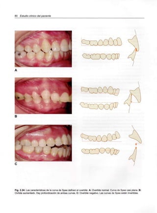 80 Estudio clínico del paciente
Fig. 2.24: Las características de la curva de Spee definen el overbite. A: Overbite normal. Curva de Spee casi plana. B:
Ovrbite aumentado. Hay profundización de ambas curvas. C: Overbite negativo. Las curvas de Spee están invertidas.
 