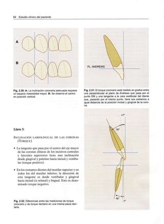 84 Estudio clínico del paciente
B
PL. ANDREWS
Fig. 2.30: A: La inclinación coronaria adecuada requiere
un espacio mesiodistal mayor. B: Se observa el canino
en posición vertical.
Fig. 2.31: El torque coronario está medido en grados entre
una perpendicular al plano de Andrews que pasa por el
punto EM y una tangente a la cara vestibular del diente
que, pasando por el mismo punto, tiene sus extremos a
igual distancia de la posición incisal y gingival de la coro-
na.
Llave 3:
INCLINACIÓN LABIOLINGUAL DE LAS CORONAS
(TORQUE)
• La tangente que pasa por el centro del eje mayor
de las coronas clínicas de los incisivos centrales
y laterales superiores tiene una inclinación
desde gingival y palatino hacia incisal y vestibu-
lar (torque positivo).
• En los restantes dientes del maxilar superior yen
todos los del maxilar inferior, la dirección de
esta tangente es desde vestibular y gingival
hacia incisal (u oclusal) y lingual. Esto es deno-
minado torque negativo.
Fig. 2.32: Diferencias entre las mediciones de torque
coronario y de torque dentario en una misma pieza den-
taria.
 