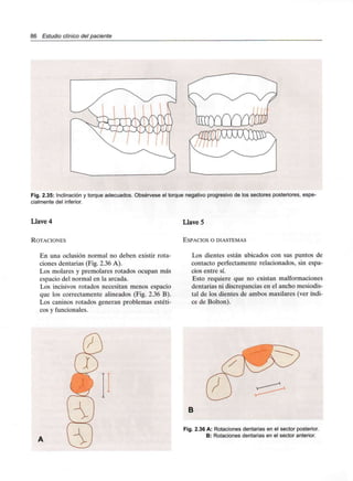 86 Estudio clínico del paciente
Fig. 2.35: Inclinación y torque adecuados. Obsérvese el torque negativo progresivo de los sectores posteriores, espe-
cialmente del inferior.
Llave 4 Llave 5
ROTACIONES ESPACIOS O DIASTEMAS
En una oclusión normal no deben existir rota-
ciones dentarias (Fig. 2.36 A).
Los molares y premolares rotados ocupan más
espacio del normal en la arcada.
Los incisivos rotados necesitan menos espacio
que los correctamente alineados (Fig. 2.36 B).
Los caninos rotados generan problemas estéti-
cos y funcionales.
Los dientes están ubicados con sus puntos de
contacto perfectamente relacionados, sin espa-
cios entre sí.
Esto requiere que no existan malformaciones
dentarias ni discrepancias en el ancho mesiodis-
tal de los dientes de ambos maxilares (ver índi-
ce de Bolton).
B
Fig. 2.36 A: Rotaciones dentarias en el sector posterior.
B: Rotaciones dentarias en el sector anterior.
 