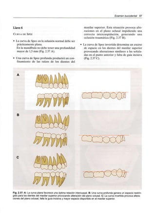 Examen bucodental 87
Llave 6
CURVA DE SPEE
• La curva de Spee en la oclusión normal debe ser
prácticamente plana.
En la mandíbulano debe tener una profundidad
mayor de 1,5mm (Fig. 2.37 A).
• Una curva de Spee profunda producirá un con-
finamiento de las raíces de los dientes del
maxilar superior. Esta situación provoca alte-
raciones en el plano oclusal impidiendo una
correcta intercuspidación, generando una
oclusión traumática (Fig. 2.37 B).
La curva de Spee invertida determina un exceso
de espacio en los dientes del maxilar superior
provocando alteraciones similares a las señala-
das en el punto anterior y falta de guía incisiva
(Fig. 2.37 C).
B
Fig. 2.37: A: La curva plana favorece una óptima relación intercuspal. B: Una curva profunda genera un espacio restrin-
gido para los dientes del maxilar superior provocando alteración del plano oclusal. C: La curva invertida provoca altera-
ciones del plano oclusal, falta la guía incisiva y mayor espacio disponible en el maxilar superior.
 