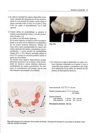 Examen bucodental 91
3. Se mide la cantidad de espacio disponible rema-
nente, después del alineamiento de los incisivos,
desde la cara mesial del primer molar hasta el
punto marcado sobre el arco en el paso 2 (Fig.
2.43). Se repite el procedimiento en el lado
opuesto
4. Usando tablas de probabilidad, se predice el
tamaño mesiodistal del canino y los dos premo-
lares (Cuadro 2.2).
La tabla se usa del modo siguiente:
En la parte superior se busca la cifra correspon-
diente a la suma de los diámetros mesiodistales
de los cuatro incisivos inferiores. Debajo de
estas cifras están encolumnados los valores del
ancho esperado del canino y premolares corres-
pondientes a varios niveles de probabilidad
(desde 95% a 5%), Moyers aconseja utilizar el
nivel 75% porque lo encontró práctico desde el
punto de vista clínico.
El método tiene algunas imprecisiones porque
diferentes pacientes con el mismo ancho mesio-
distal de incisivos tienen distintos diámetros
mediodistales de canino y premolares. No obs-
tante, lo consideramos útil porque nos da una
idea bastante aproximada a la realidad.
Fig. 2.43.
5. Se relaciona el espacio disponible en ambos sec-
tores laterales (obtenido en el punto 3) con el
requerido para caninos y premolares que surge
de la utilización de las tablas. Se obtiene de esta
manera la discrepancia dentaria.
Suma anchos M - D 2 -1 1 -2 = 24 mm.
Espacio necesario para 3 - 4 - 5 = 22,8 mm.
(ver tablas)
Espacio presente:
Lado derecho = 19 mm Dif.: -3,8 mm
Lado izquierdo = 23 mm Dif.: 0,2 mm
Discrepancia dentaria: -3,6 mm
Fig. 2.44: Ejemplo de la utilización de las tablas de Moyers. Discrepancia dentaria en una arcada en dentición mixta,
obtenida mediante las tablas.
 