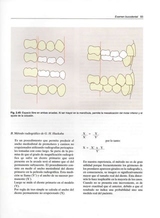 Examen bucodental 93
Fig. 2.45: Espacio libre en ambas arcadas. Al ser mayor en la mandíbula,permite la mesialización del molar inferior y el
ajuste de laoclusión.
B. Método radiográfico de G. H. Huckaba
Es un procedimiento que permite predecir el
ancho mediodistal de premolares y caninos no
erupcionados utilizando radiografíaspericapica-
les tomadas con cono largo. Se parte de la pre-
misa de que el grado de magnificación radiográ-
fica qe sufre un diente primario que está
presente en la arcada será el mismo que el del
permanente subyacente. El procedimiento con-
siste en medir el ancho mesiodistal del diente
primario en la película radiográfica. Esta medi-
ción se llama (Y') y el ancho de su sucesor per-
manente (X').
Luego se mide el diente primario en el modelo
(Y).
Por regla de tres simple se calcula el ancho del
diente permantente no erupcionado (X).
X = Y
por lo tanto:
X = X' x Y
En nuestra esperiencia, el método no es de gran
utilidad porque frecuentemente los gérmenes de
los premiares aparecen girados en la radiografíay,
en consecuencia, su imagen essignificativamente
mayor que el tamaño real del diente. Esta distor-
sión lo hace inaplicable en la mayoría de los casos.
Cuando no se presenta este incoveniente, es de
mayor exactitud que el anterior, debido a que el
resultado no indica una probabilidad sino una
medida real del paciente.
 