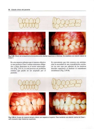 98 Estudio clínico del paciente
Fig. 2.49: Efecto de la desarmonía de tamaños entre dientes superiores e inferiores. Se establece una relación lateral de
Clase II.
De esta manera sabemos que si nuestro objetivo
es una perfecta Clase I canina estaremos obliga-
dos a dejar diastemas en el sector anterosupe-
rior (Fig. 2.50 A), lo cual provoca un problema
estético que puede no ser aceptado por el
paciente.
Es conveniente que éste conozca con anticipa-
ción la necesidad de una remodelación corona-
ria (en este caso por adición) de los incisivos
laterales superiores al finalizar el tratamiento
ortodóncico (Fig. 2.50 B).
Fig. 2.50 A: Exceso de material dentario inferior con respecto al superior. Para mantener una relación canina de Clase I,
será necesario dejar diastemas superiores.
 