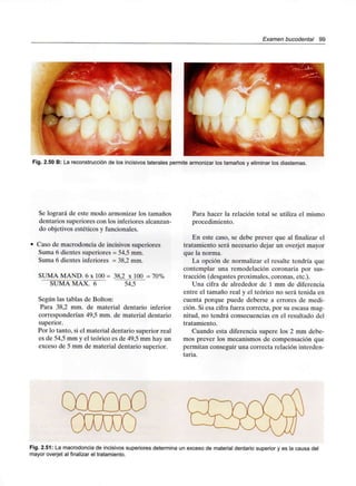 Examen bucodental 99
Fig. 2.50 B: La reconstrucción de los incisivos laterales permite armonizar los tamaños y eliminar los diastemas.
Se logrará de este modo armonizar los tamaños
dentarios superiores con los inferioresalcanzan-
do objetivos estéticos y funcionales.
Caso de macrodoncia de incisivos superiores
Suma 6 dientes superiores = 54.5 mm.
Suma 6 dientes inferiores = 38,2 mm.
SUMA MAND. 6 x 100 = 38,2 x 100 = 70%
SUMA MAX. 6 54,5
Según las tablas de Bolton:
Para 38,2 mm. de material dentario inferior
corresponderían 49,5 mm. de material dentario
superior.
Por lo tanto, si el material dentario superior real
es de 54,5 mm y el teórico es de 49,5 mm hay un
exceso de 5 mm de material dentario superior.
Para hacer la relación total se utiliza el mismo
procedimiento.
En este caso, se debe prever que al finalizar el
tratamiento será necesario dejar un overjet mayor
que la norma.
La opción de normalizar el resalte tendría que
contemplar una remodelación coronaria por sus-
tracción (desgastes proximales, coronas, etc.).
Una cifra de alrededor de 1 mm de diferencia
entre el tamaño real y el teórico no será tenida en
cuenta porque puede deberse a errores de medi-
ción. Si esa cifra fuera correcta, por su escasa mag-
nitud, no tendrá consecuencias en el resultado del
tratamiento.
Cuando esta diferencia supere los 2 mm debe-
mos prever los mecanismos de compensación que
permitan conseguir una correcta relación interden-
taria.
Fig. 2.51: La macrodoncia de incisivos superiores determina un exceso de material dentario superior y es la causa del
mayor overjet al finalizar el tratamiento.
 