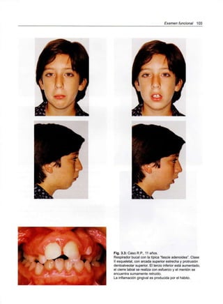 Examen funcional 103
Fig. 3.3: Caso R.P., 11 años.
Respirador bucal con la típica "fascie adenoidea". Clase
II esqueletal, con arcada superior estrecha y protrusión
dentoalveolar superior. El tercio inferior está aumentado,
el cierre labial se realiza con esfuerzo y el mentón se
encuentra sumamente retruido.
La inflamación gingival es producida por el hábito.
 