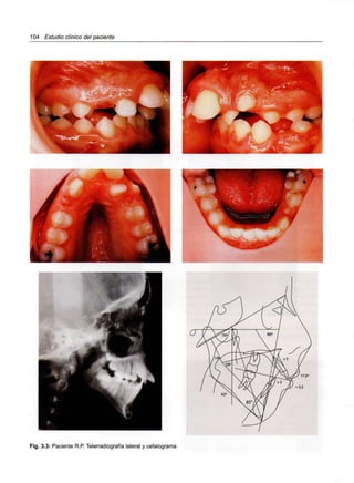 104 Estudio clínico del paciente
Fig. 3.3: Paciente R.P. Telerradiografía lateral y cefalograma
 
