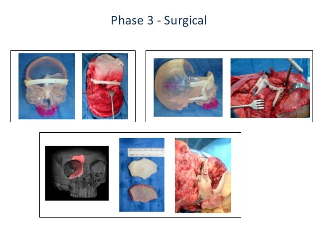 Viagra use before surgery