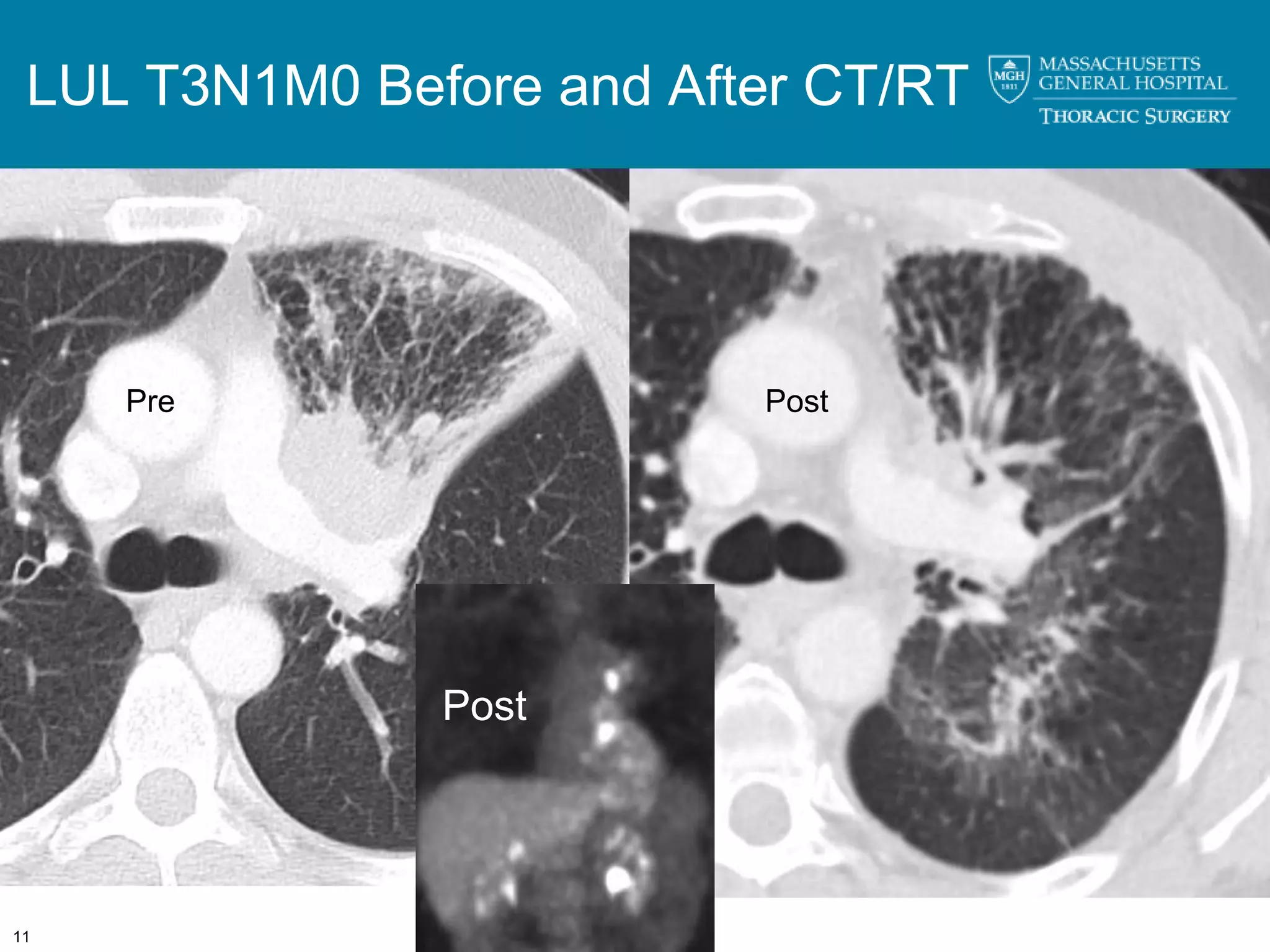 LUL T3N1M0 Before and After CT/RT




     Pre                  Post




               Post




11
 
