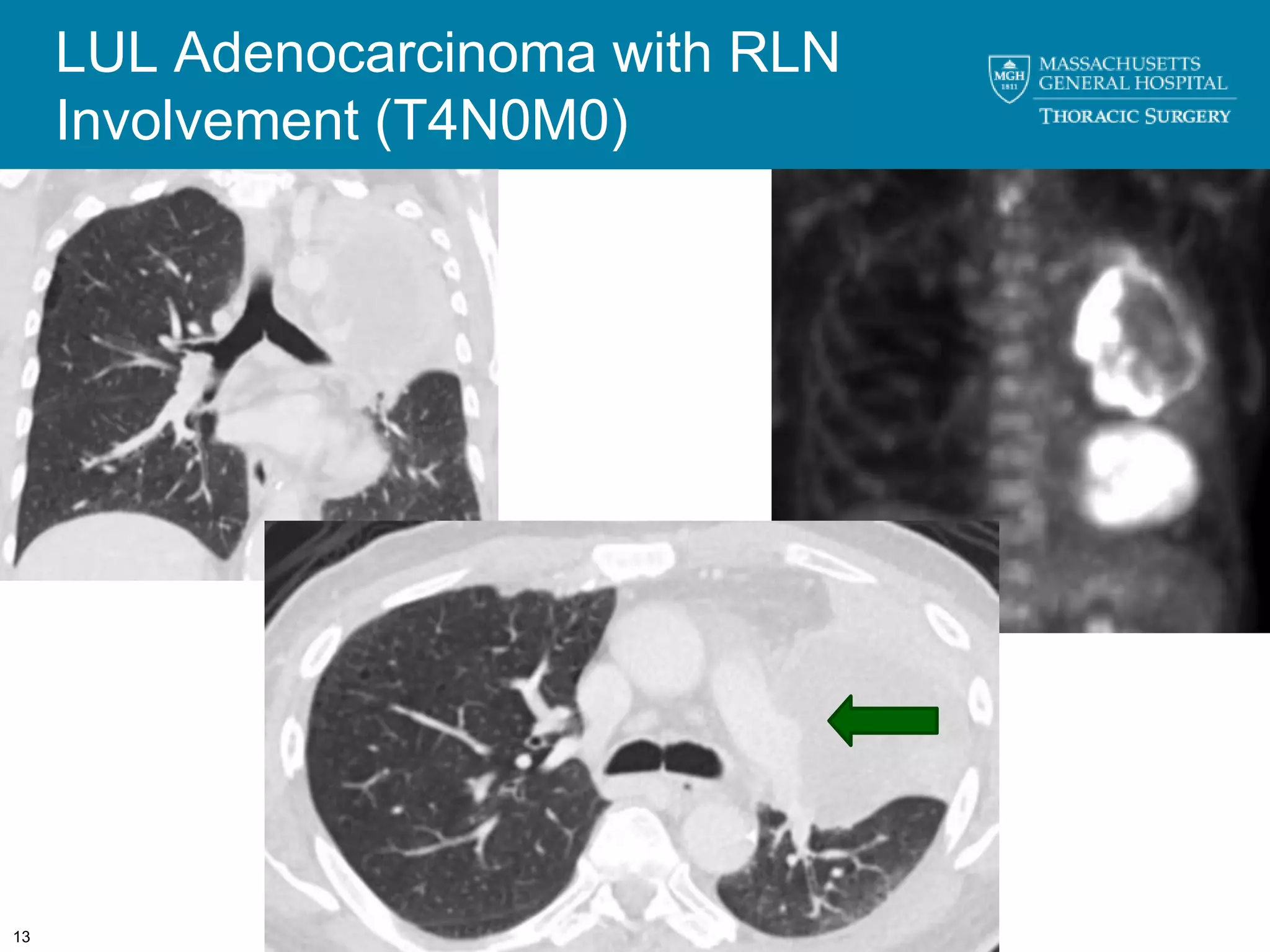 LUL Adenocarcinoma with RLN
     Involvement (T4N0M0)




13
 