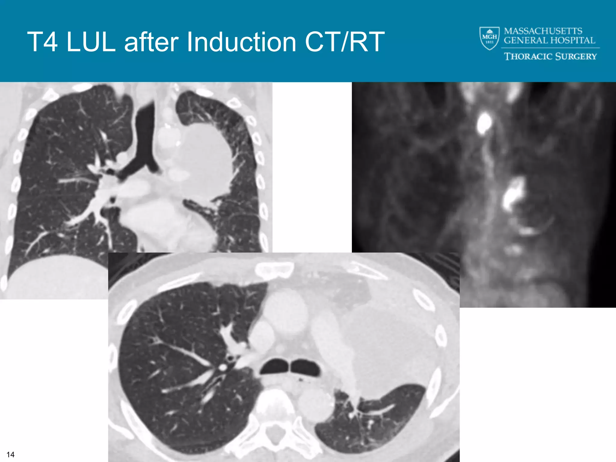 T4 LUL after Induction CT/RT




14
 