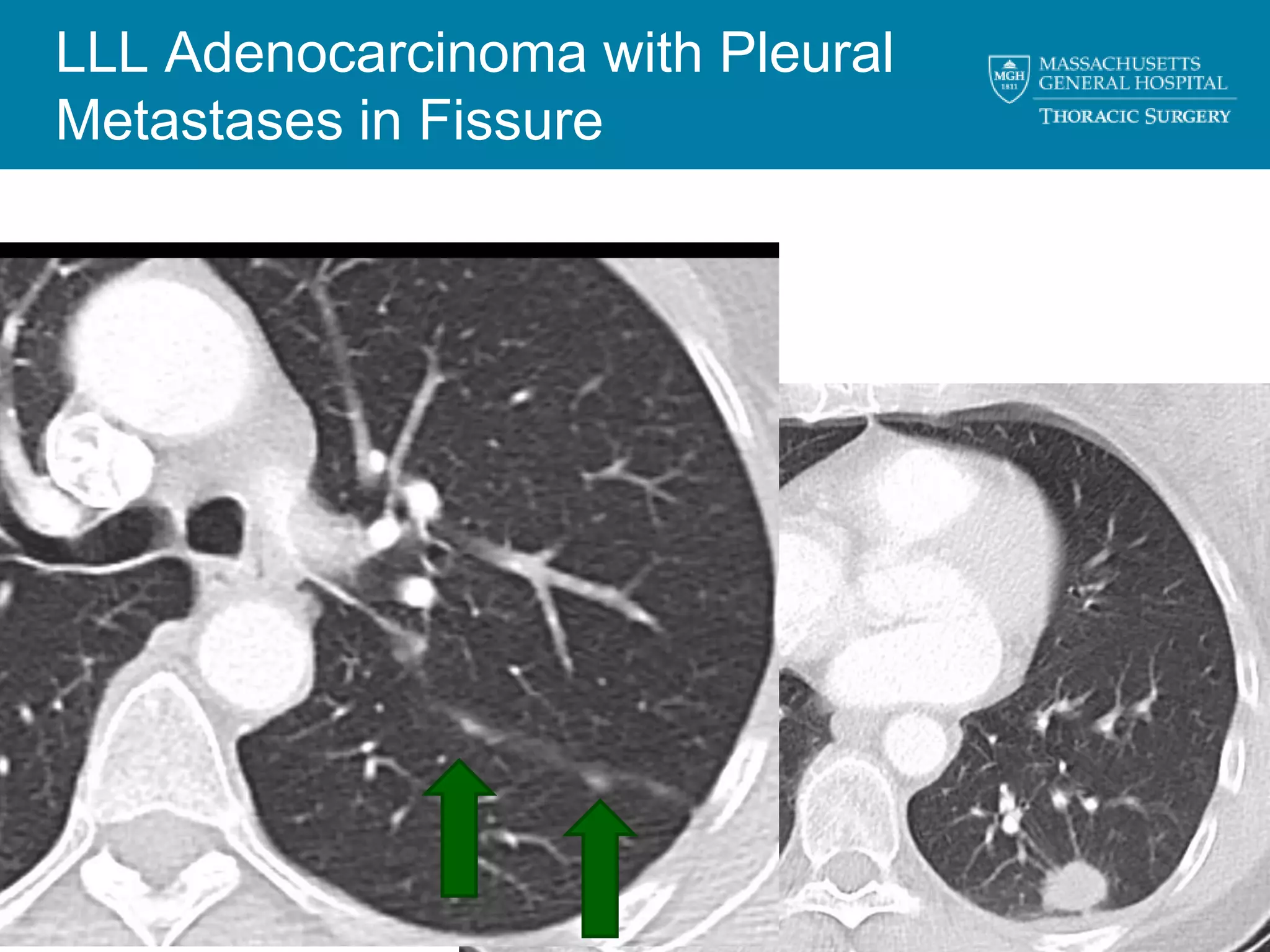 LLL Adenocarcinoma with Pleural
    Metastases in Fissure




4
 