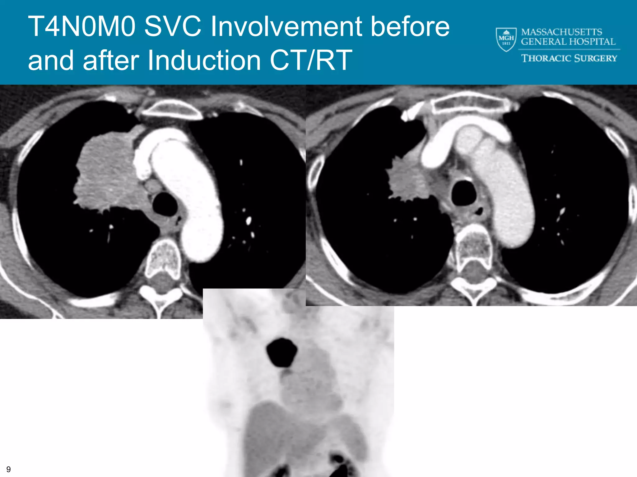 T4N0M0 SVC Involvement before
    and after Induction CT/RT




9
 