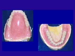 Processing of Complete denture prosthodontics.pptx
