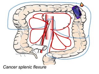 Splenic Fixurfe Standardization of CME for Transverse Colon Cancer | PPTX