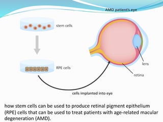 how stem cells can be used to produce retinal pigment epithelium
(RPE) cells that can be used to treat patients with age-related macular
degeneration (AMD).
 