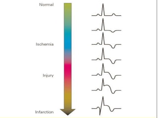 15504781-ISCHEMIA-LEZIUNEA-I-NECROZA-POWERPOINT.ppt