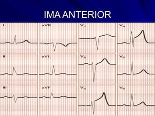 IMA ANTERIOR
 
