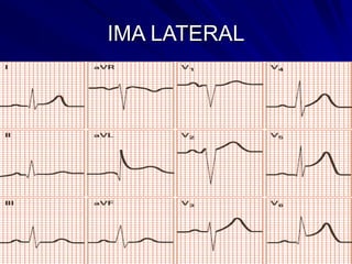 IMA LATERAL
 