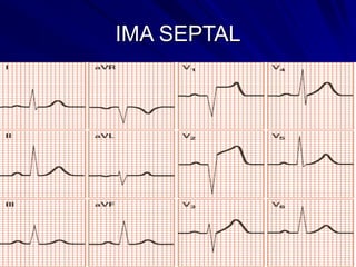 IMA SEPTAL
 