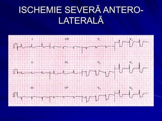 ISCHEMIE SEVERĂ ANTERO-
LATERALĂ
 