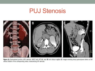CT urography | PPTX