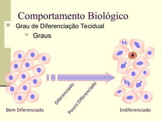 Comportamento Biológico
 Grau de Diferenciação Tecidual
 Graus
Bem Diferenciado Indiferenciado
D
i
f
e
r
e
n
c
i
a
d
o
P
o
u
c
o
D
i
f
e
r
e
n
c
i
a
d
o
 