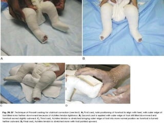 1557906 Congenital Talipes Equino Varus.ppt