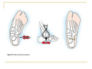 1557906 Congenital Talipes Equino Varus.ppt
