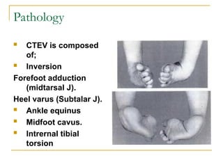 1557906 Congenital Talipes Equino Varus.ppt