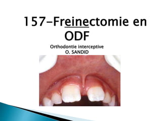 157-Freinectomie en
ODF
Orthodontie interceptive
O. SANDID
Orthodontiste
 