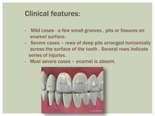 Clinical features:
- Mild cases - a few small grooves , pits or fissures on
enamel surface.
- Severe cases – rows of deep pits arranged horizontally
across the surface of the tooth . Several rows indicate
series of injuries.
- Most severe cases – enamel is absent.
 