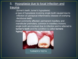 5. Hypoplasia due to local infection and
trauma
(turner’s teeth, turner’s hypoplasia)
-a type of hypoplasia involving single tooth caused due to
infection on periapical inflammatory disease of overlying
deciduous teeth.
-most commonly affected- permanent maxillary and
mandibular premolars, common in maxillary incisors.
single tooth are involved due to infection and is referred to
turner's teeth and the condition is called turners
hypoplasia.
TURNER’S TEETH
 