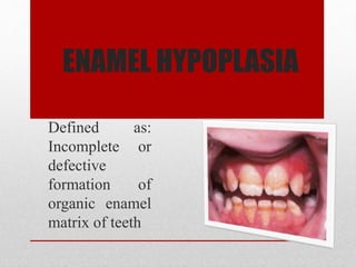 ENAMEL HYPOPLASIA
Defined as:
Incomplete or
defective
formation of
organic enamel
matrix of teeth
 