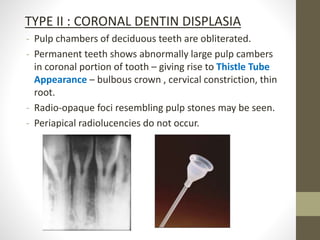 TYPE II : CORONAL DENTIN DISPLASIA
- Pulp chambers of deciduous teeth are obliterated.
- Permanent teeth shows abnormally large pulp cambers
in coronal portion of tooth – giving rise to Thistle Tube
Appearance – bulbous crown , cervical constriction, thin
root.
- Radio-opaque foci resembling pulp stones may be seen.
- Periapical radiolucencies do not occur.
 