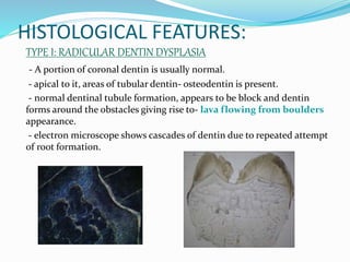HISTOLOGICAL FEATURES:
TYPE I: RADICULAR DENTIN DYSPLASIA
- A portion of coronal dentin is usually normal.
- apical to it, areas of tubular dentin- osteodentin is present.
- normal dentinal tubule formation, appears to be block and dentin
forms around the obstacles giving rise to- lava flowing from boulders
appearance.
- electron microscope shows cascades of dentin due to repeated attempt
of root formation.
 