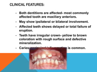CLINICAL FEATURES:
- Both dentitions are affected- most commonly
affected tooth are maxillary anteriors.
- May show ipsilateral or bilateral involvement.
- Affected teeth shows delayed or total failure of
eruption.
- Teeth have irregular crown- yellow to brown
coloration with rough surface and defective
mineralization.
- Caries, periapical inflammation is common.
 