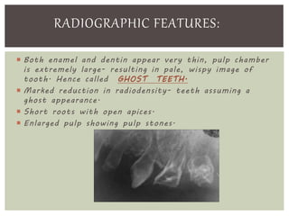  Both enamel and dentin appear very thin, pulp chamber
is extremely large- resulting in pale, wispy image of
tooth. Hence called GHOST TEETH.
 Marked reduction in radiodensity- teeth assuming a
ghost appearance.
 Short roots with open apices.
 Enlarged pulp showing pulp stones.
RADIOGRAPHIC FEATURES:
 