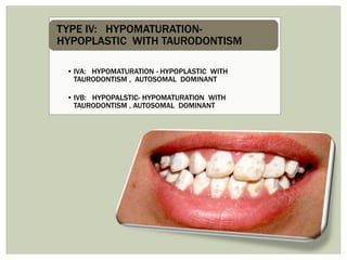 • IVA: HYPOMATURATION - HYPOPLASTIC WITH
TAURODONTISM , AUTOSOMAL DOMINANT
• IVB: HYPOPALSTIC- HYPOMATURATION WITH
TAURODONTISM , AUTOSOMAL DOMINANT
TYPE IV: HYPOMATURATION-
HYPOPLASTIC WITH TAURODONTISM
 