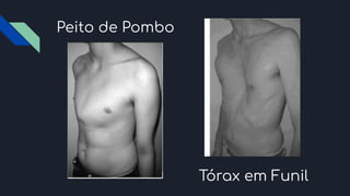 Peito de Pombo
Tórax em Funil
 