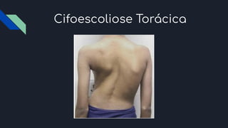Cifoescoliose Torácica
 