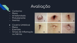 Avaliação
● Contorno:
- Plano
- Arredondado
- Protuberante
- Avental
● Cicatriz Umbilical
- Plana
- Evertida
- Sinais de Inﬂamação
ou hérnia
 