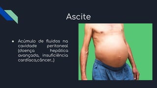 Ascite
● Acúmulo de ﬂuidos na
cavidade peritoneal
(doença hepática
avançada, insuﬁciência
cardíaca,câncer...)
 