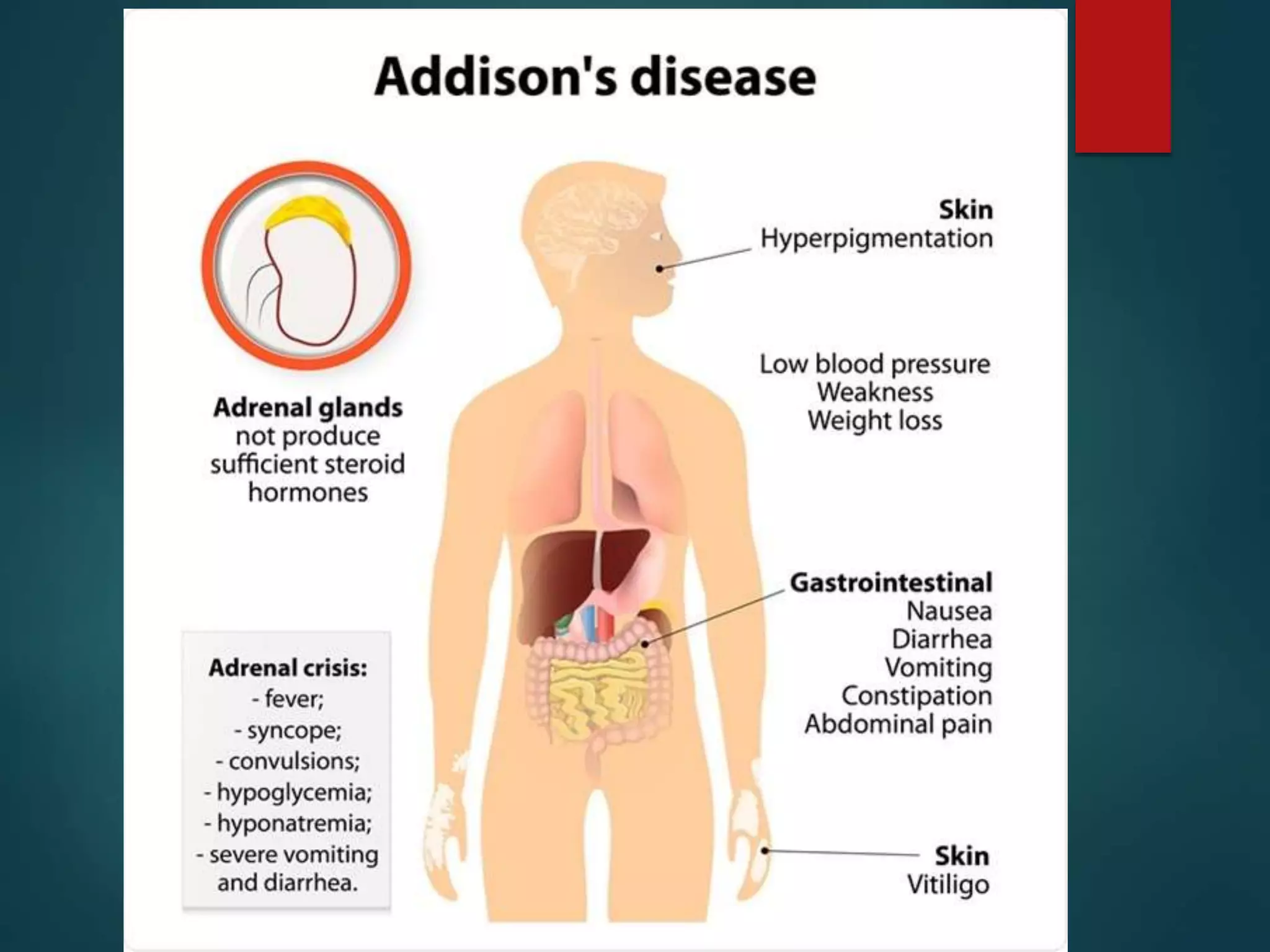 addison's disease ppt by ankita patel | PPTX