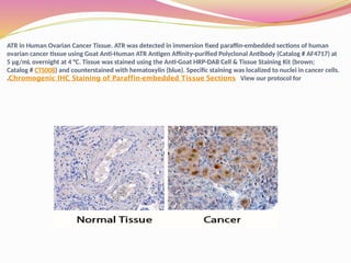 ATR in Human Ovarian Cancer Tissue. ATR was detected in immersion fixed paraffin-embedded sections of human
ovarian cancer tissue using Goat Anti-Human ATR Antigen Affinity-purified Polyclonal Antibody (Catalog # AF4717) at
5 µg/mL overnight at 4 °C. Tissue was stained using the Anti-Goat HRP-DAB Cell & Tissue Staining Kit (brown;
Catalog # CTS008) and counterstained with hematoxylin (blue). Specific staining was localized to nuclei in cancer cells.
View our protocol for
Chromogenic IHC Staining of Paraffin-embedded Tissue Sections
.
 