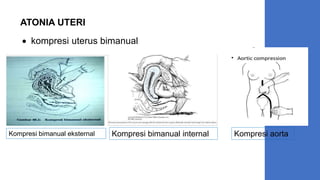  kompresi uterus bimanual
ATONIA UTERI
Kompresi bimanual internal
Kompresi bimanual eksternal Kompresi aorta
 
