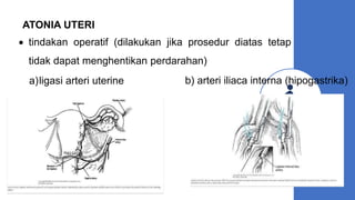 ATONIA UTERI
 tindakan operatif (dilakukan jika prosedur diatas tetap
tidak dapat menghentikan perdarahan)
a)ligasi arteri uterine b) arteri iliaca interna (hipogastrika)
 