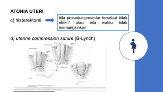 ATONIA UTERI
c) histerektomi
bila prosedur-prosedur tersebut tidak
efektif atau bila waktu tidak
memungkinkan
d) uterine compression suture (B-Lynch)
 