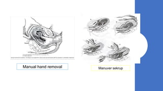 Manual hand removal Manuver sekrup
 